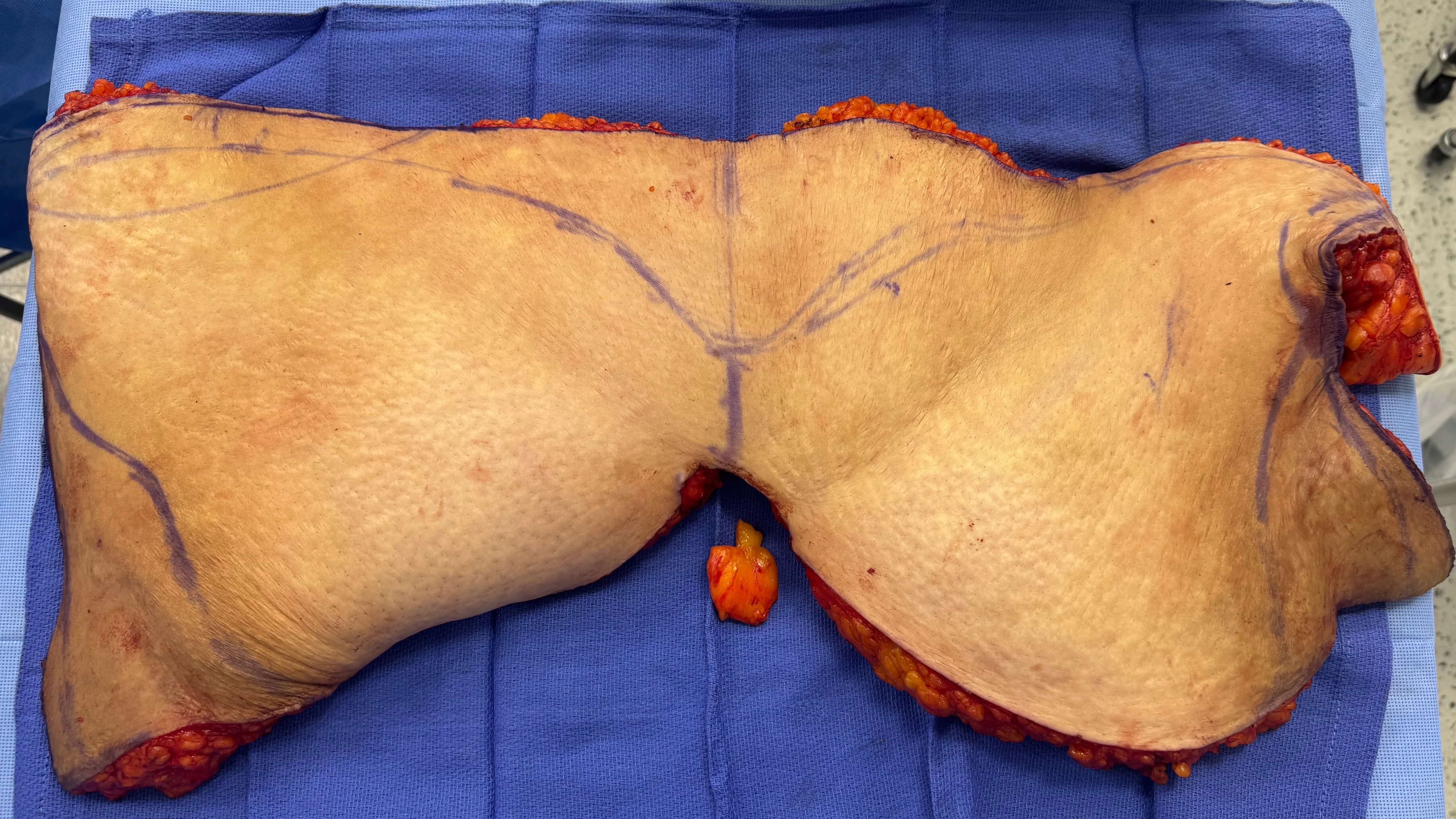 Fat removed during abdominopla